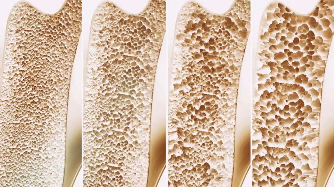 O que é Osteoporose?