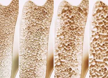 O que é Osteoporose?